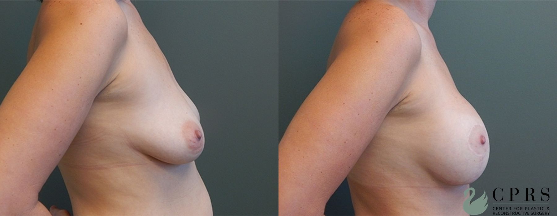 Before and after Mommy Makeover case 18946 - Angle 5