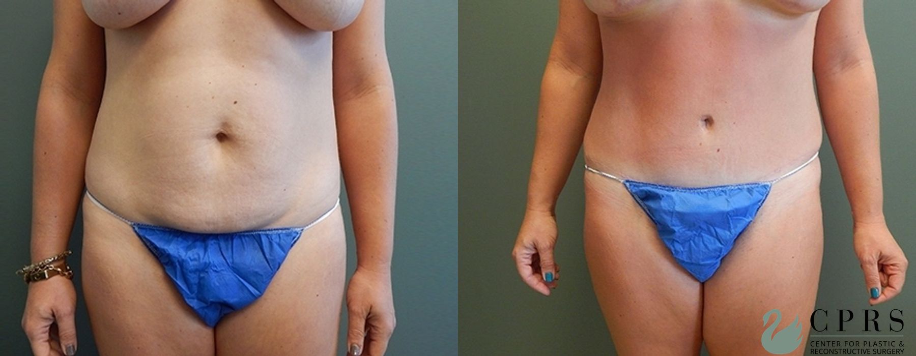 Before and after Mommy Makeover case 18931