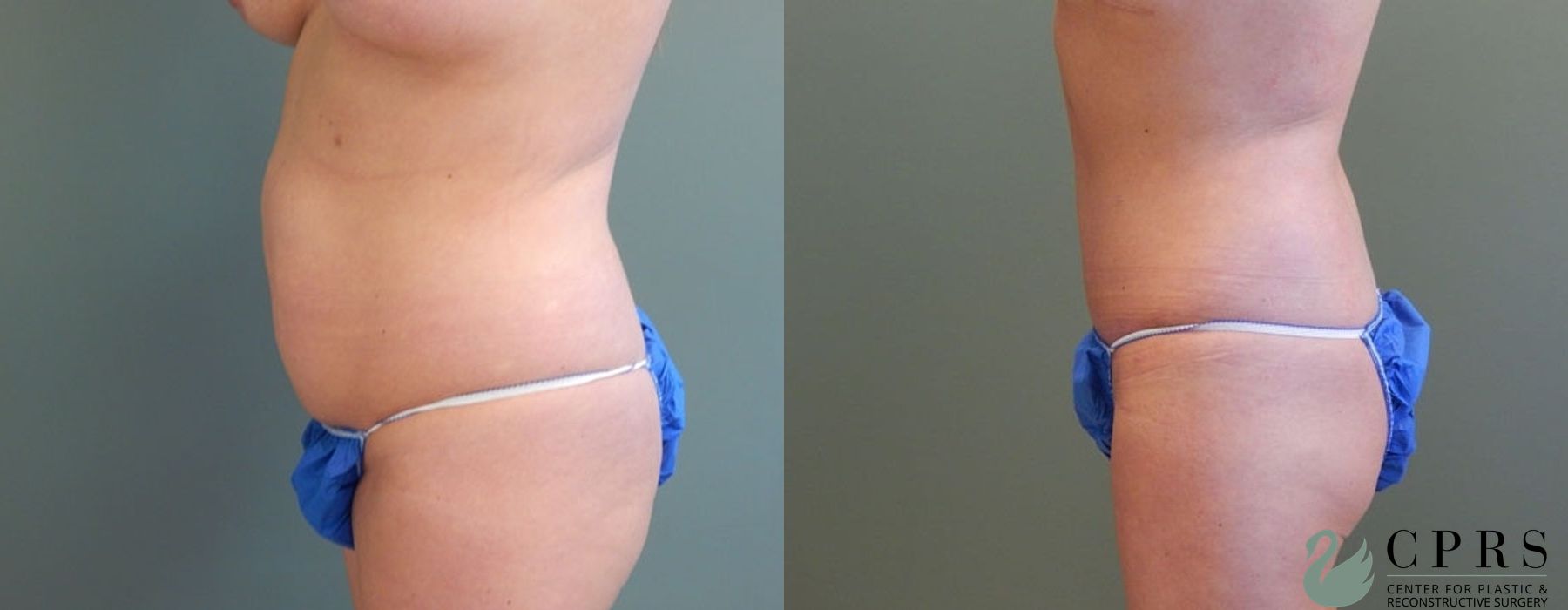 Before and after Mommy Makeover case 18923 - Angle 3