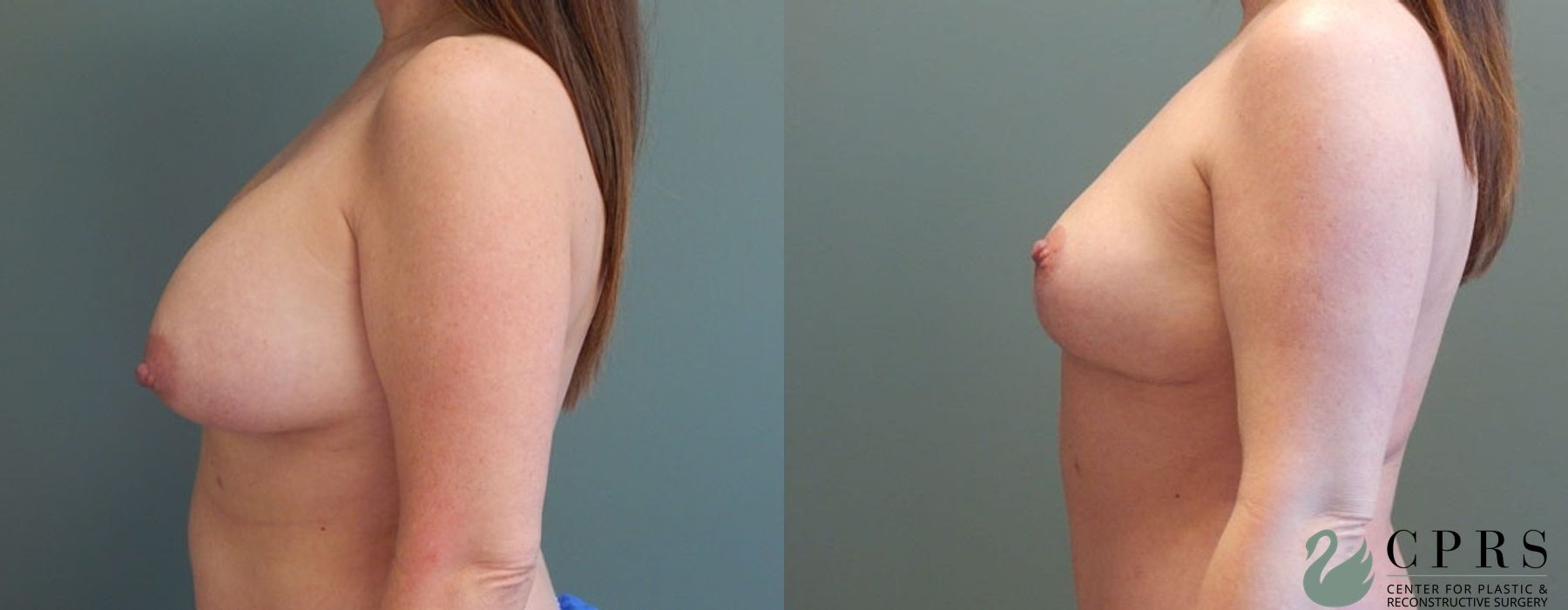 Before and after Mommy Makeover case 18923 - Angle 6