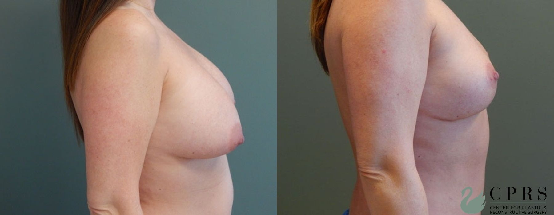 Before and after Mommy Makeover case 18923 - Angle 5