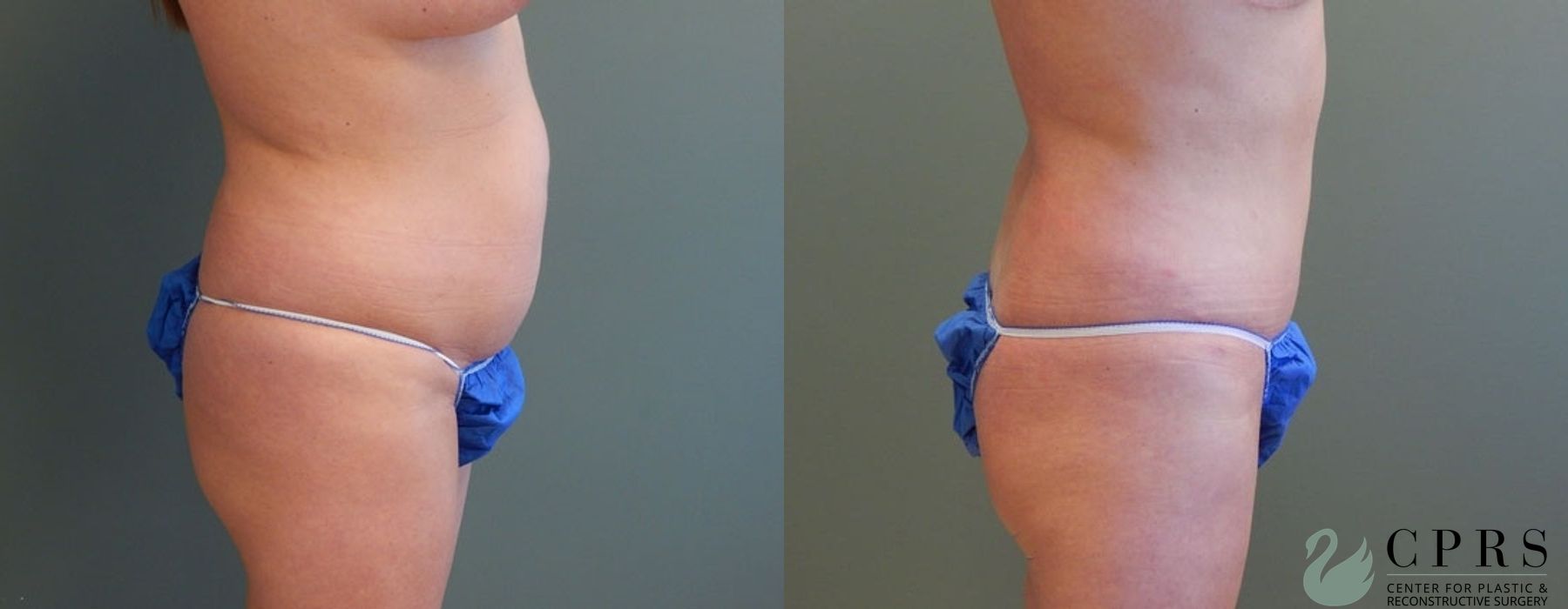 Before and after Mommy Makeover case 18923 - Angle 2