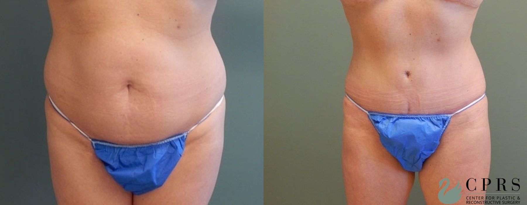 Before and after Mommy Makeover case 18923