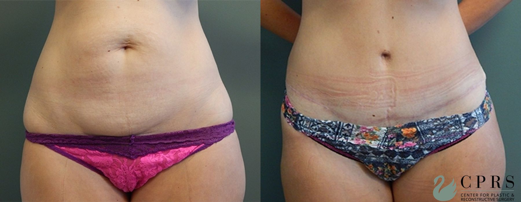 Before and after Mommy Makeover case 18946