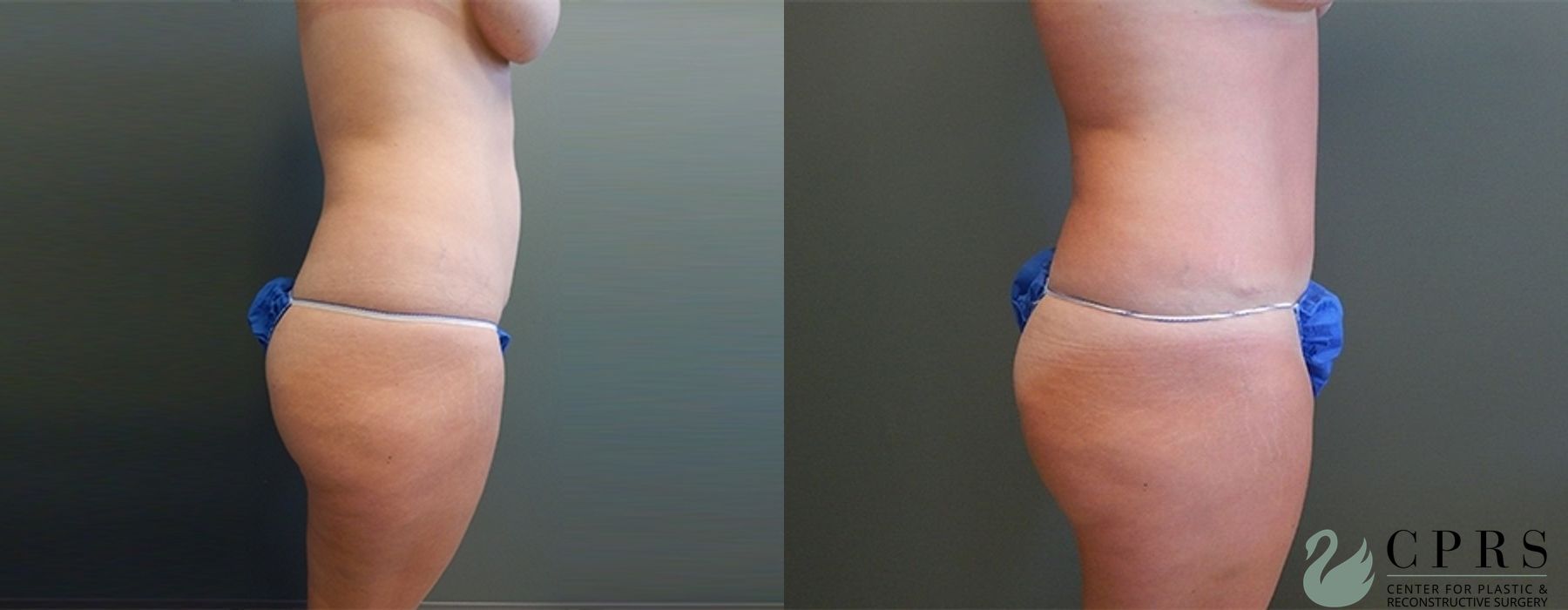 Before and after Mommy Makeover case 18931 - Angle 3