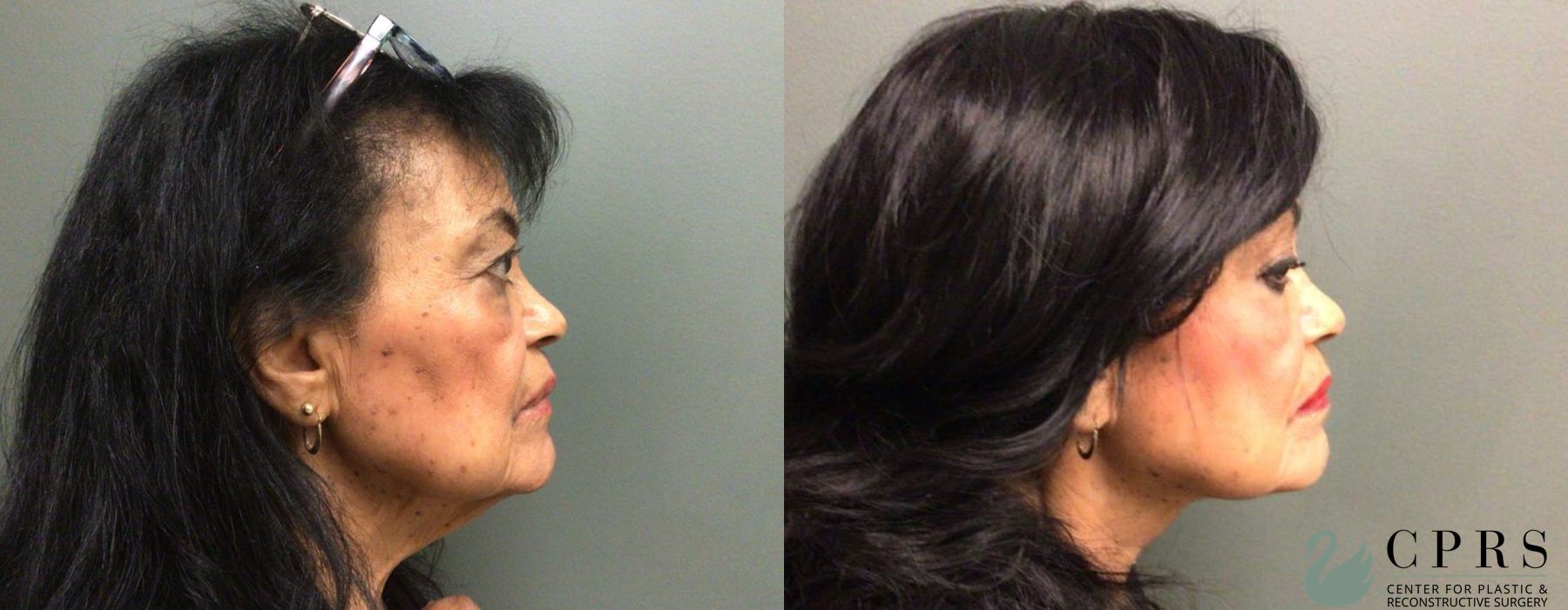 Before and after Neck Lift case 19147 - Angle 2