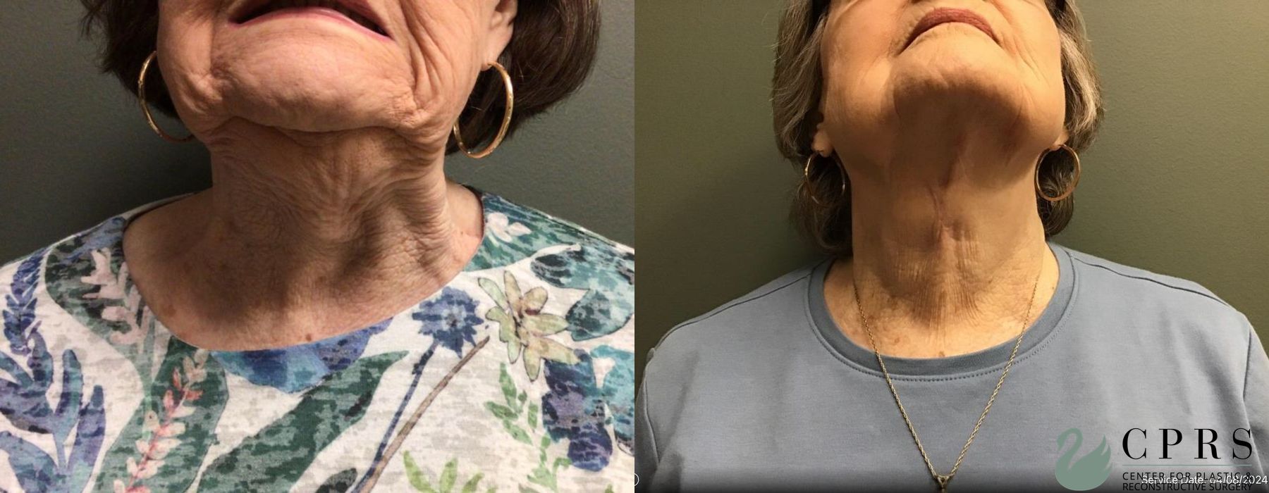 Before and after Neck Lift case 19128