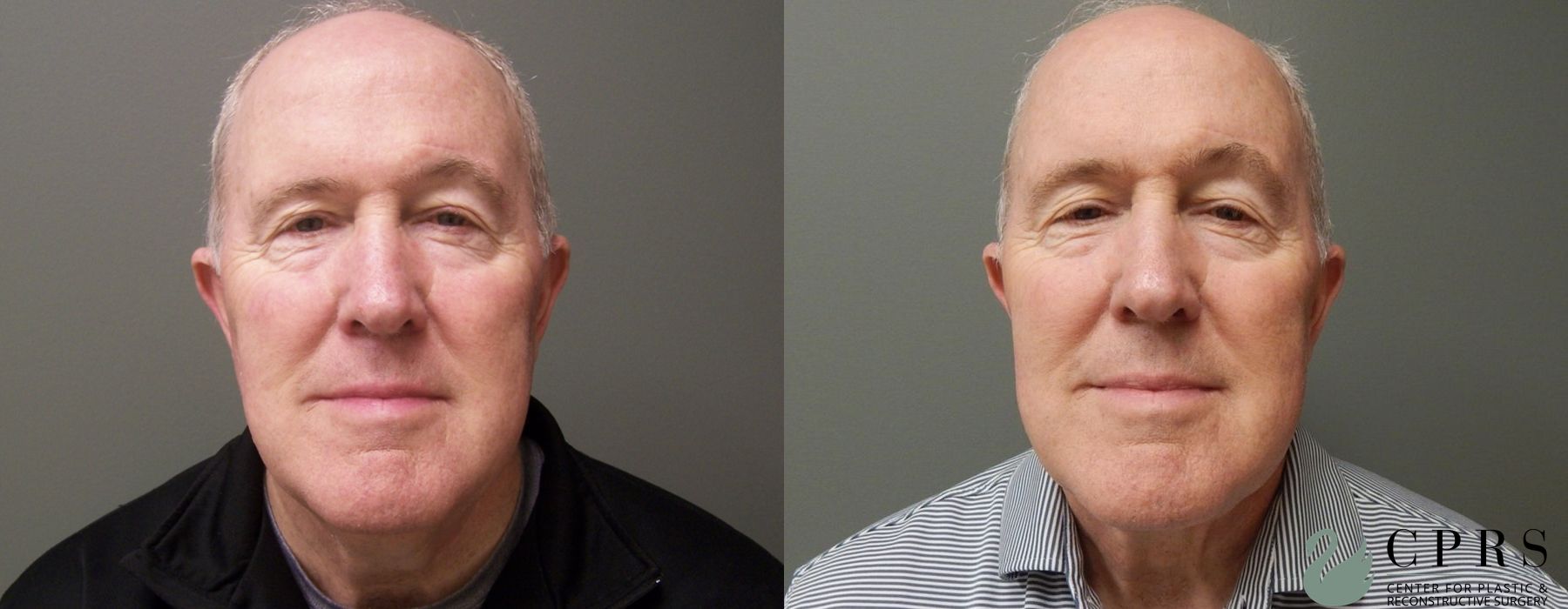 Before and after Neck Lift case 19080