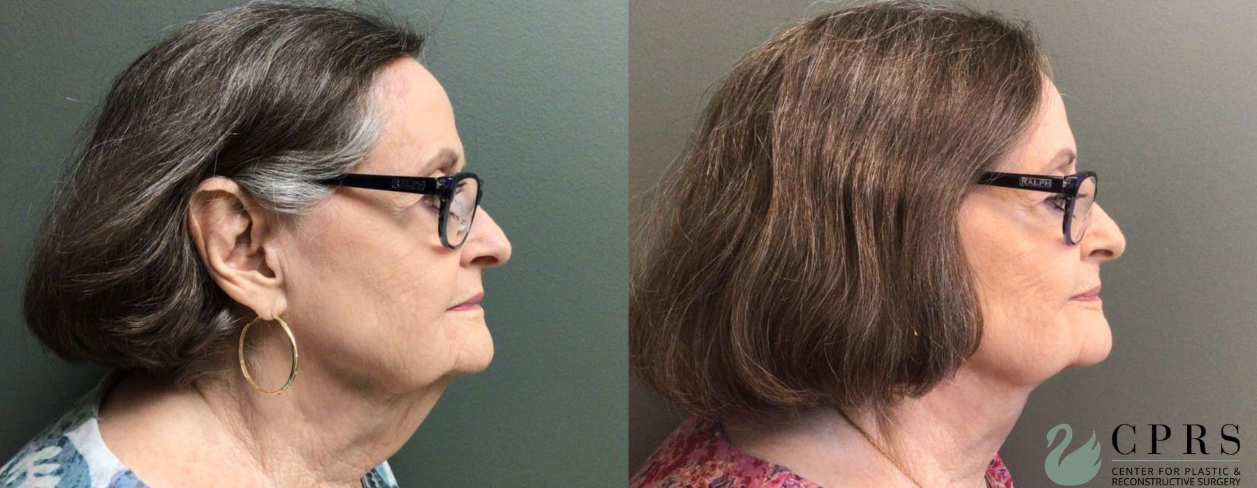Before and after Neck Lift case 19128 - Angle 2