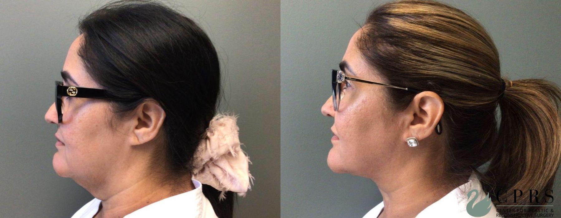 Before and after Neck Lift case 19018 - Angle 3