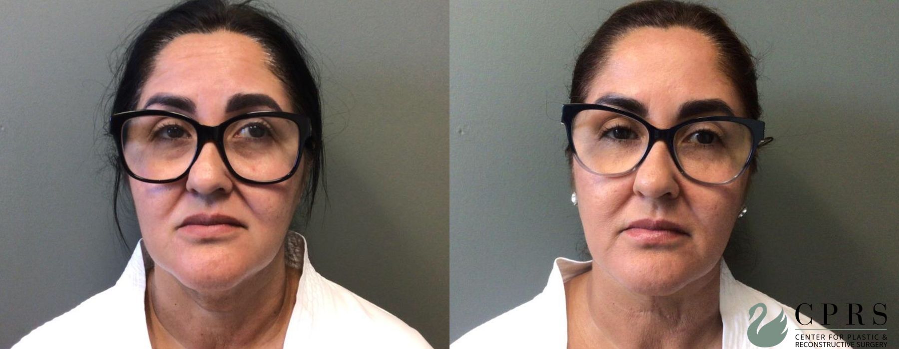 Before and after Neck Lift case 19018
