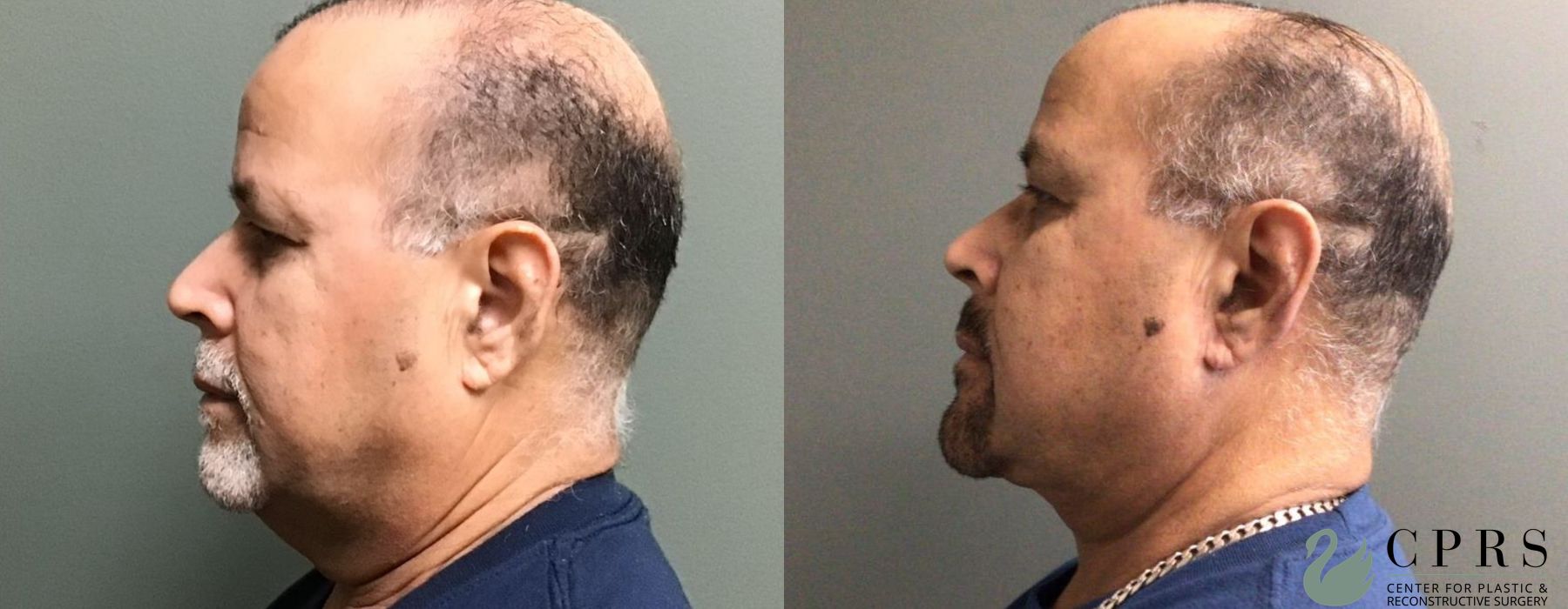 Before and after Neck Lift case 19020 - Angle 3