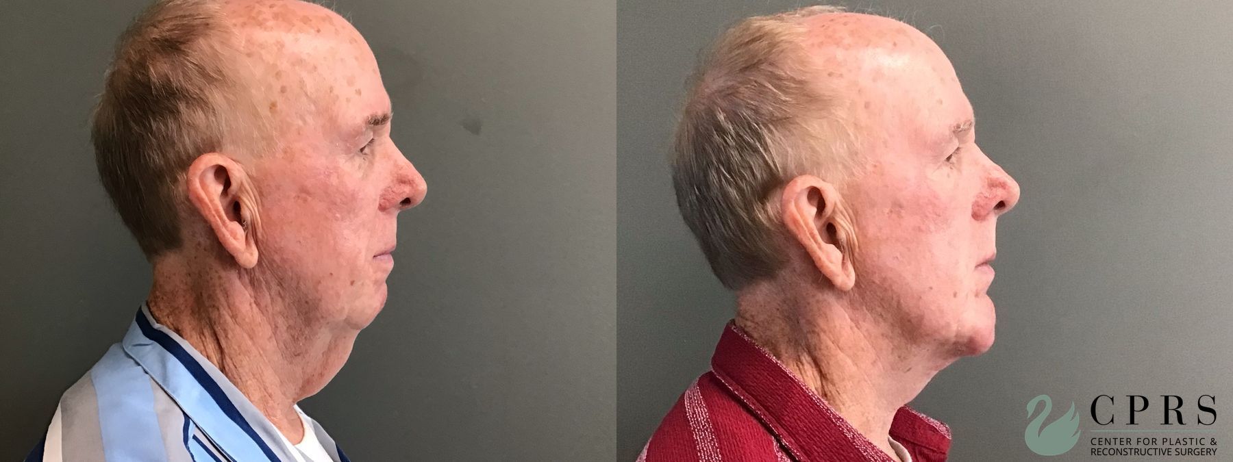 Before and after Neck Lift case 49378