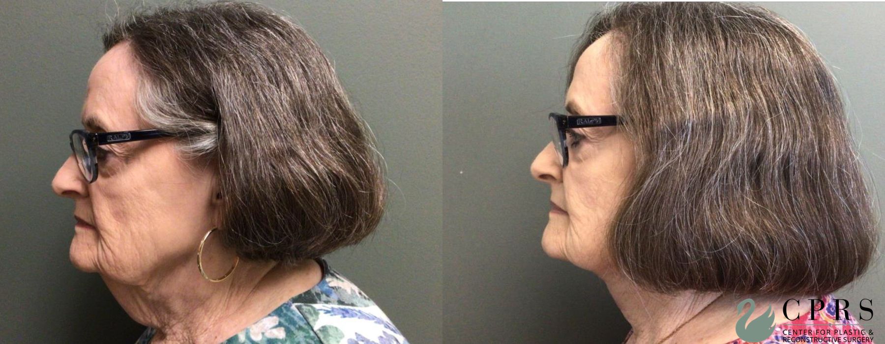 Before and after Neck Lift case 19128 - Angle 3