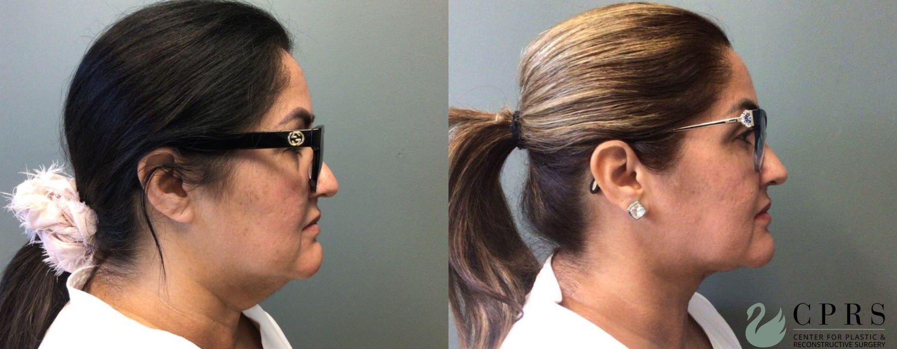 Before and after Neck Lift case 19018 - Angle 2