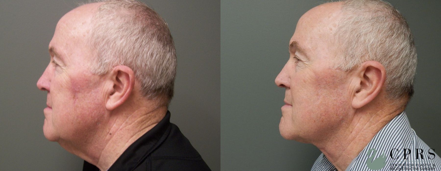Before and after Neck Lift case 19080 - Angle 3