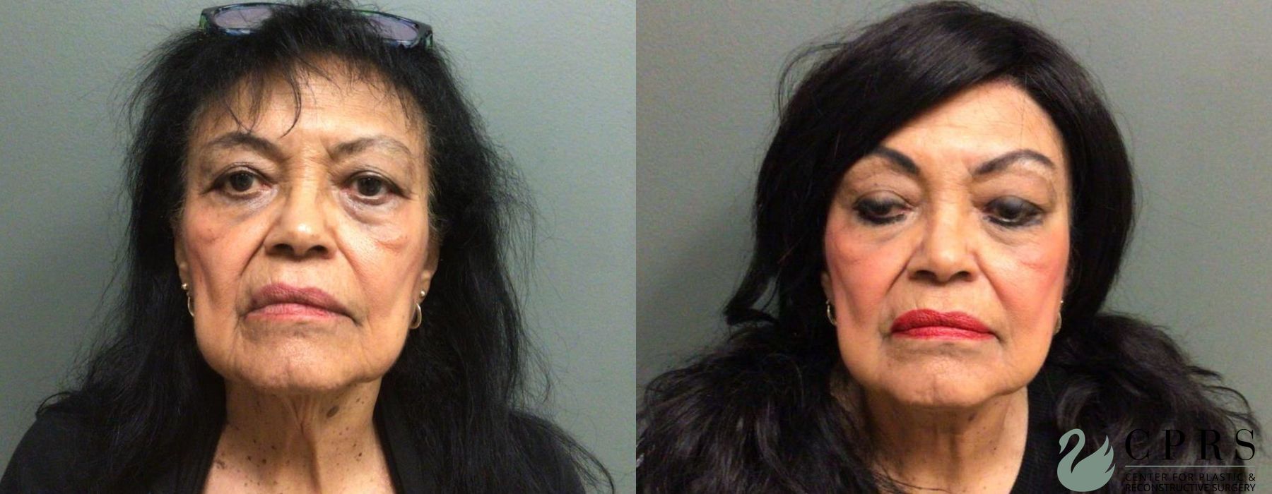 Before and after Neck Lift case 19147