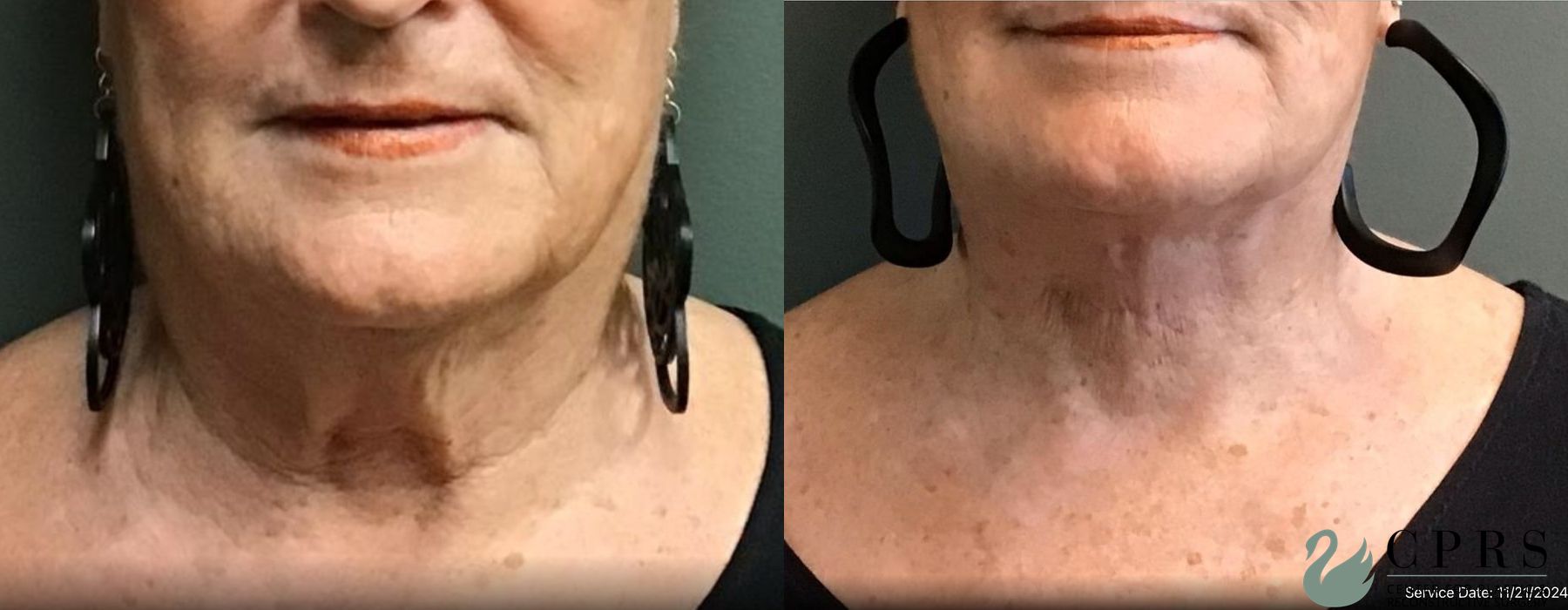 Before and after Neck Lift case 19026