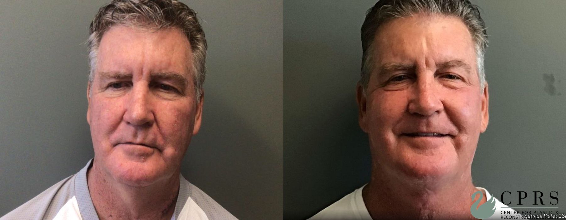 Before and after Neck Lift case 19033