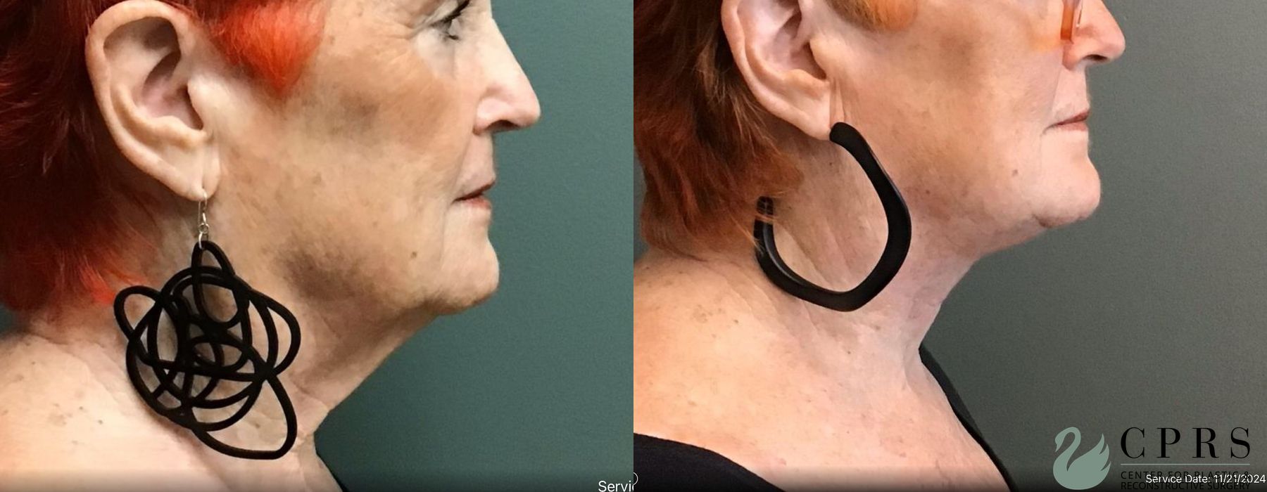 Before and after Neck Lift case 19026 - Angle 2