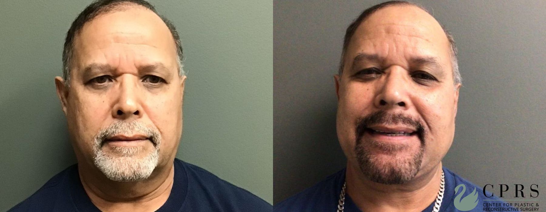 Before and after Neck Lift case 19020
