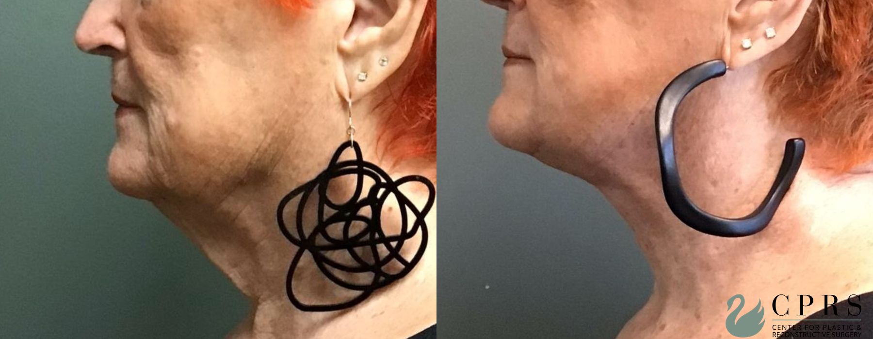 Before and after Neck Lift case 19026 - Angle 3
