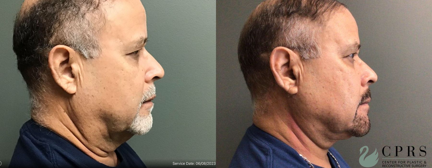 Before and after Neck Lift case 19020 - Angle 2