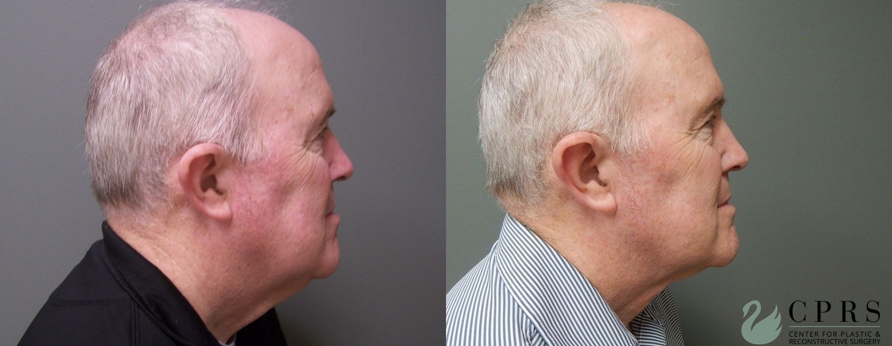 Before and after Neck Lift case 19080 - Angle 2