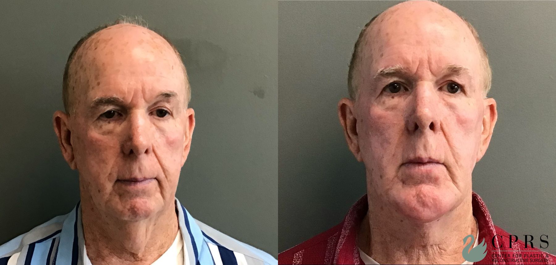 Before and after Neck Lift case 49378 - Angle 3