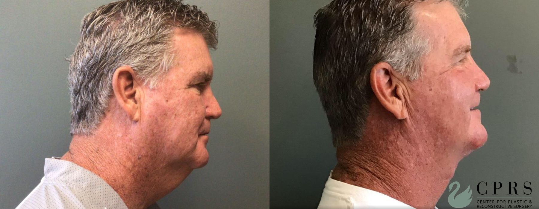 Before and after Neck Lift case 19033 - Angle 2