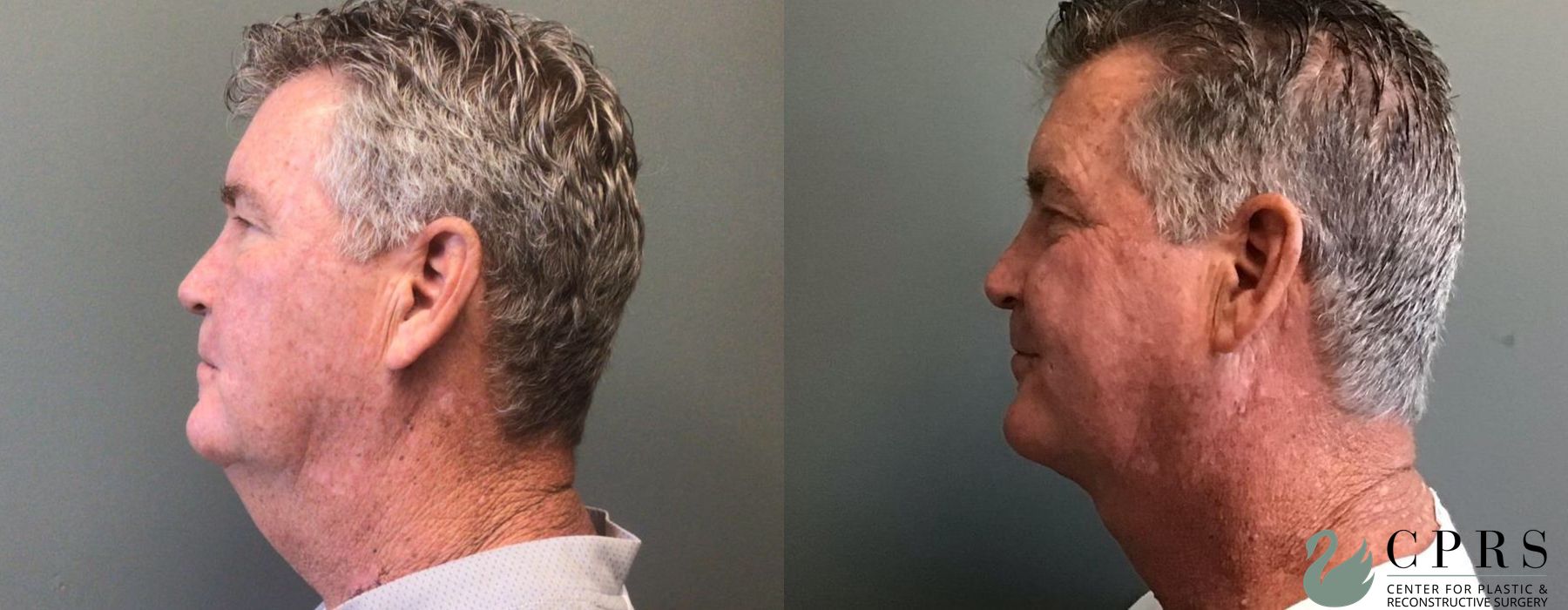 Before and after Neck Lift case 19033 - Angle 3