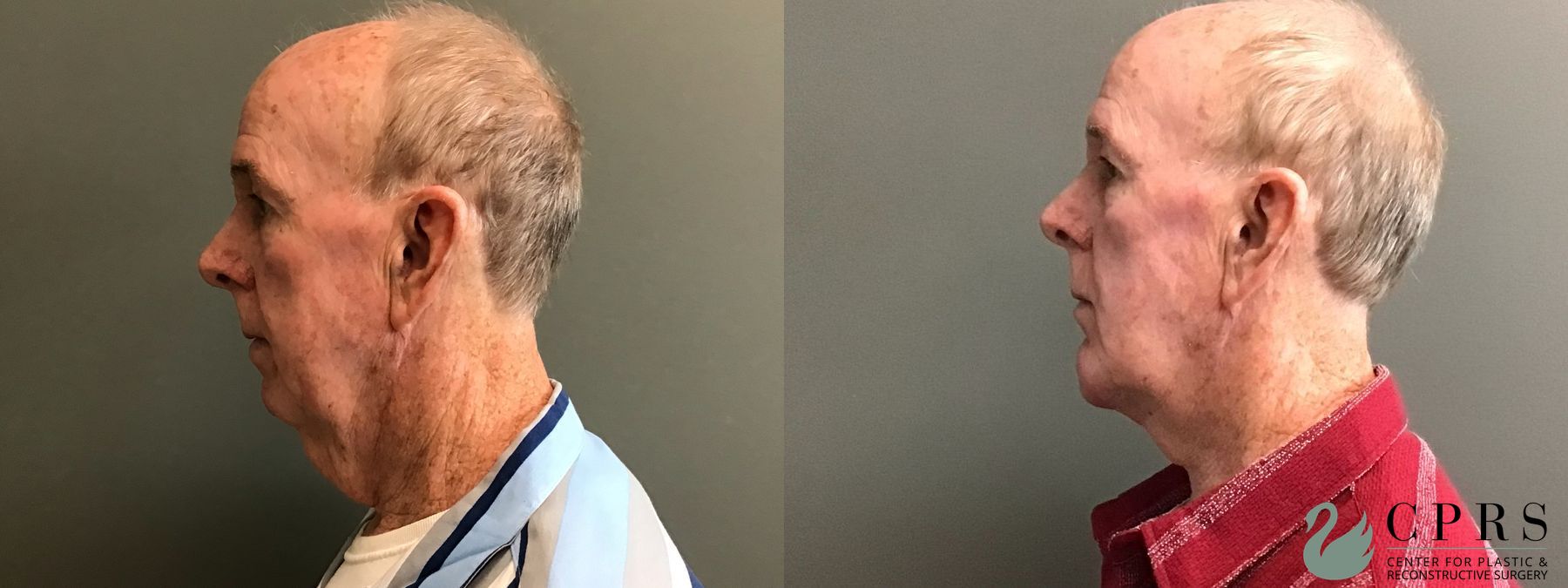 Before and after Neck Lift case 49378 - Angle 2