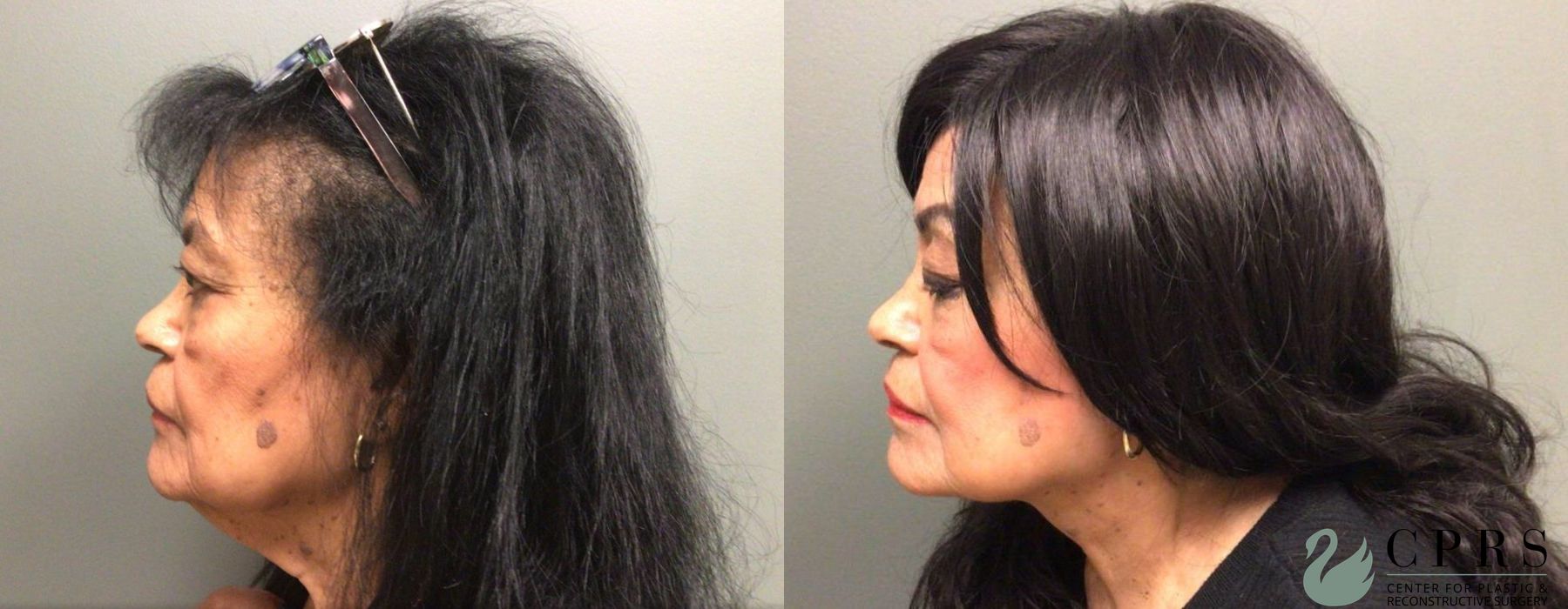 Before and after Neck Lift case 19147 - Angle 3