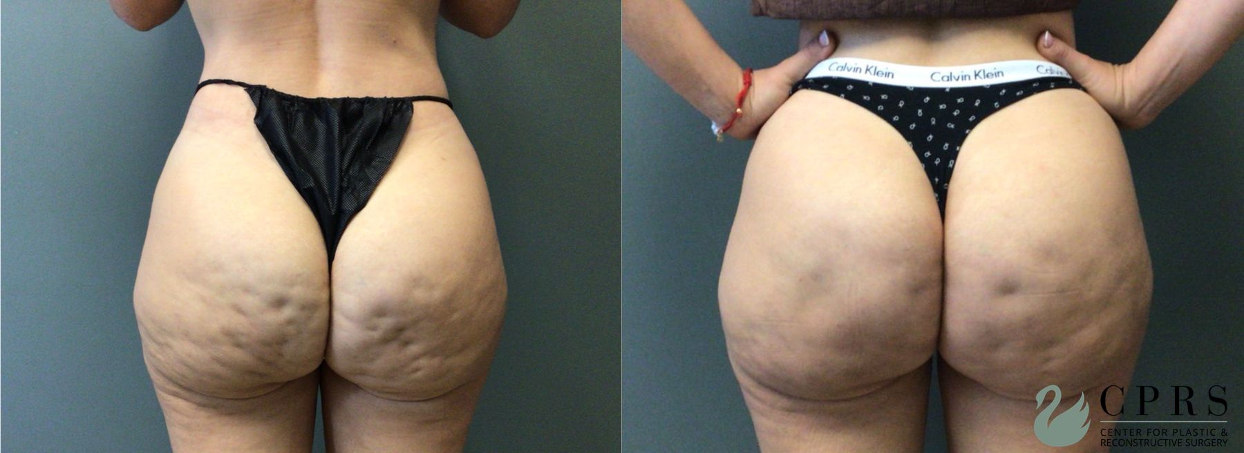 Before and after Non-surgical Body Sculpting case 43071