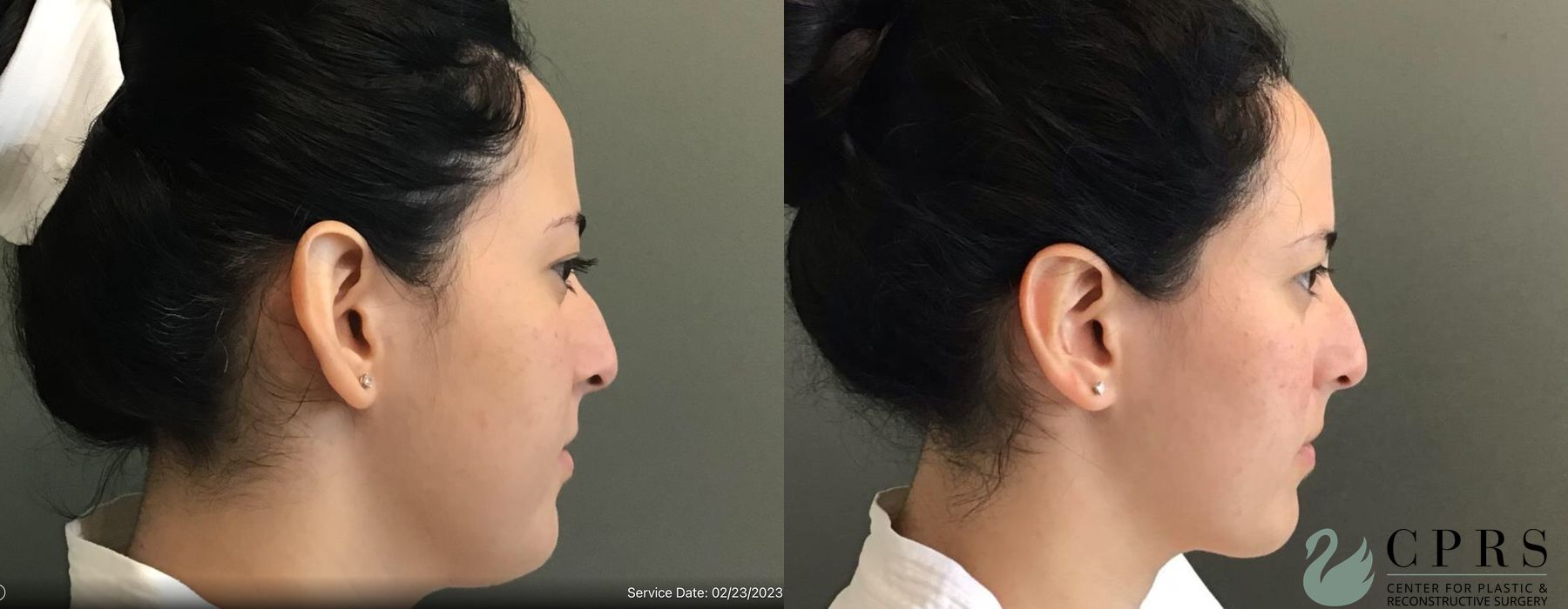 Before and after Otoplasty case 19186 - Angle 3