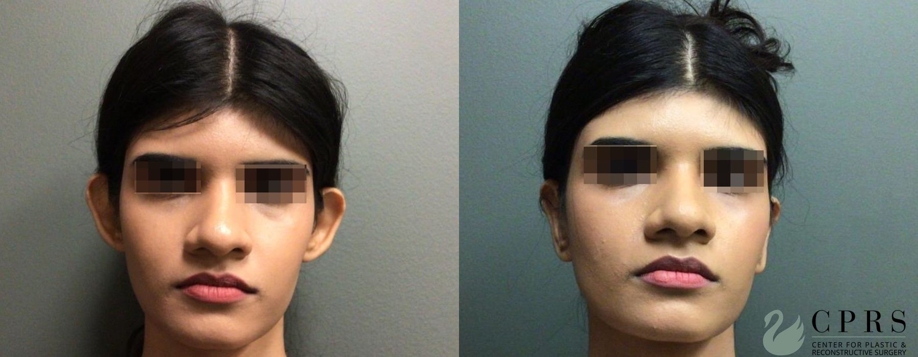 Before and after Otoplasty case 19188
