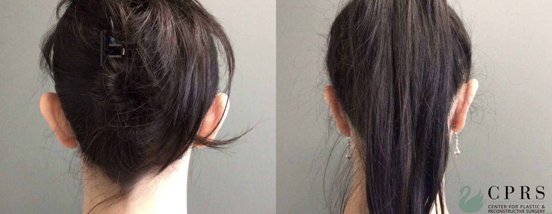 Before and after Otoplasty case 19105