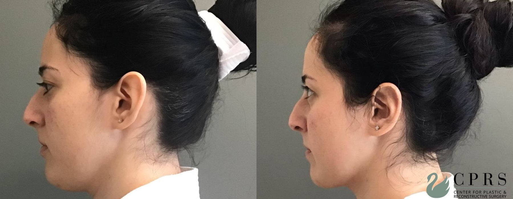Before and after Otoplasty case 19186 - Angle 2