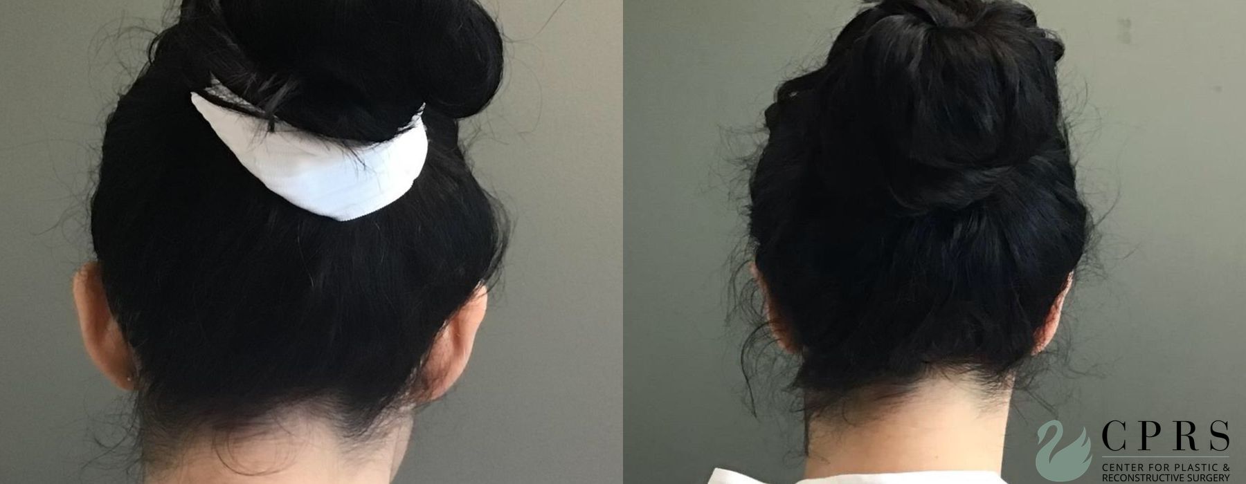 Before and after Otoplasty case 19186 - Angle 4