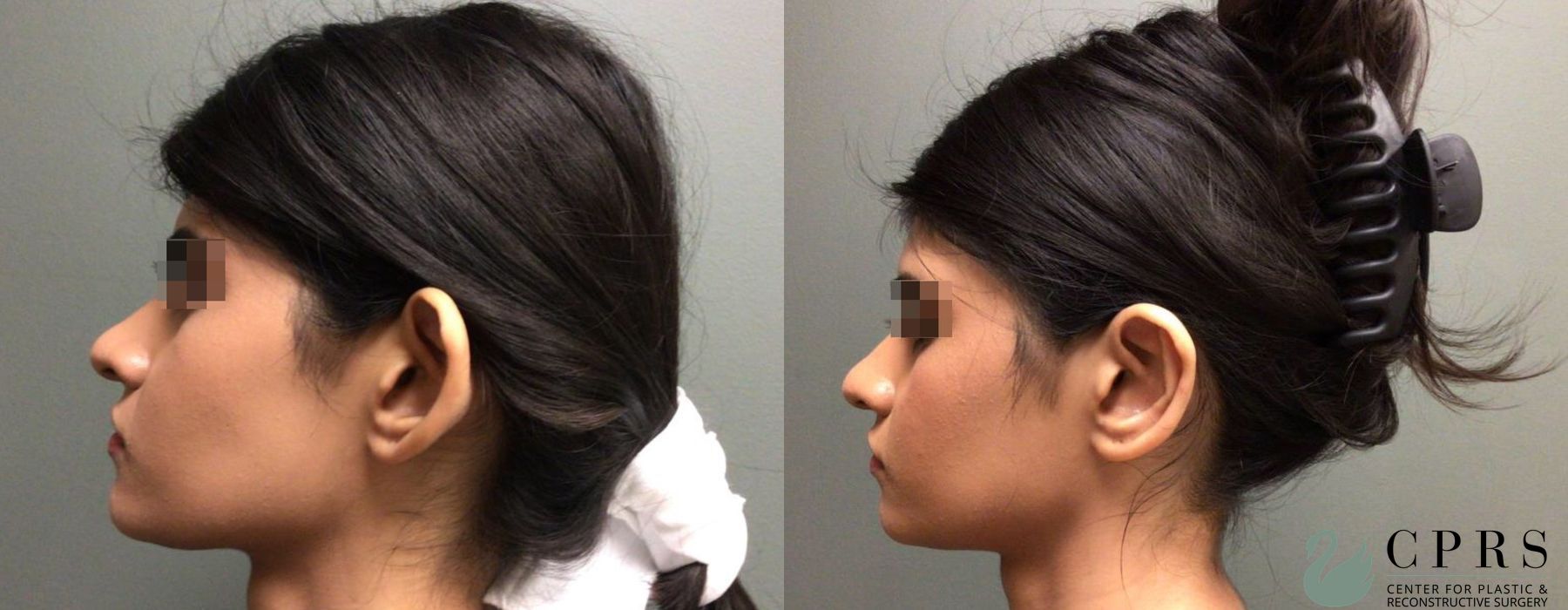 Before and after Otoplasty case 19188 - Angle 4