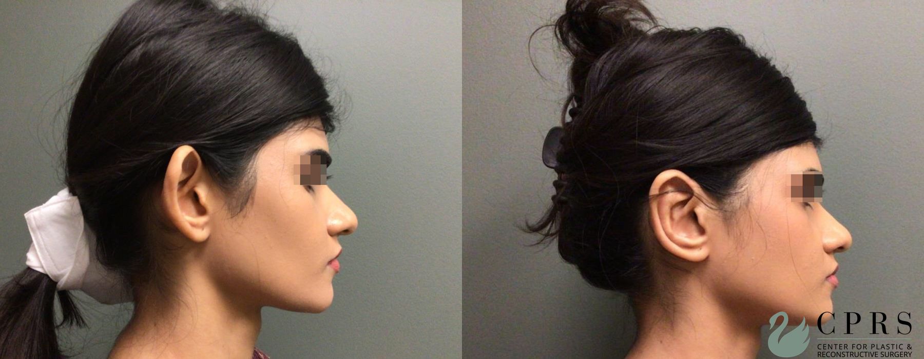 Before and after Otoplasty case 19188 - Angle 3