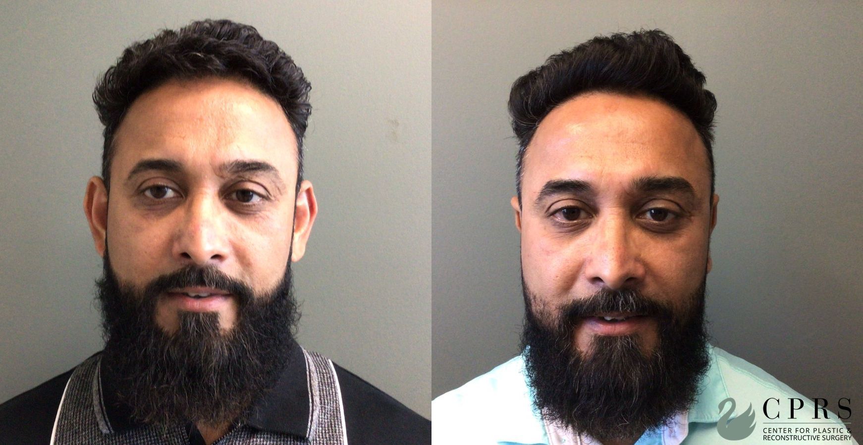 Before and after Otoplasty case 49515