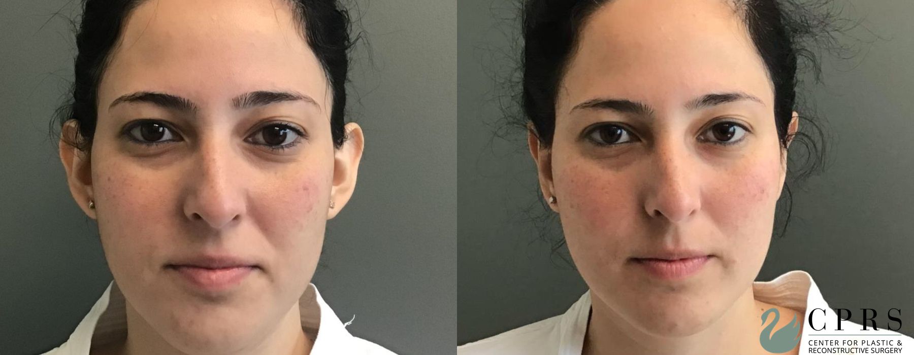 Before and after Otoplasty case 19186