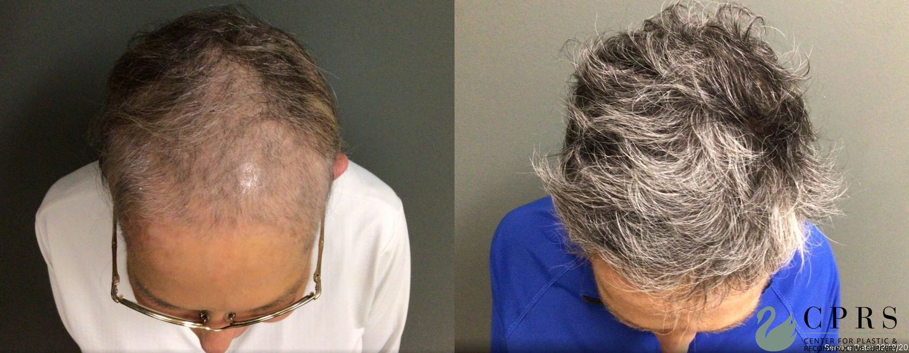 PRP Hair Restoration - Case 239801