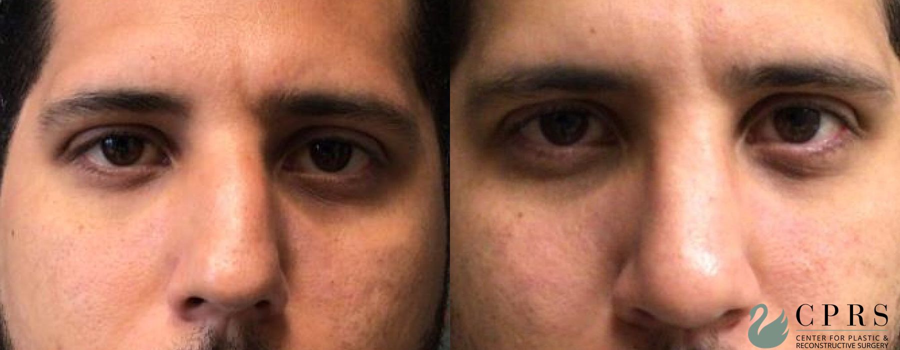 Before and after Rhinoplasty case 19075 - Angle 2