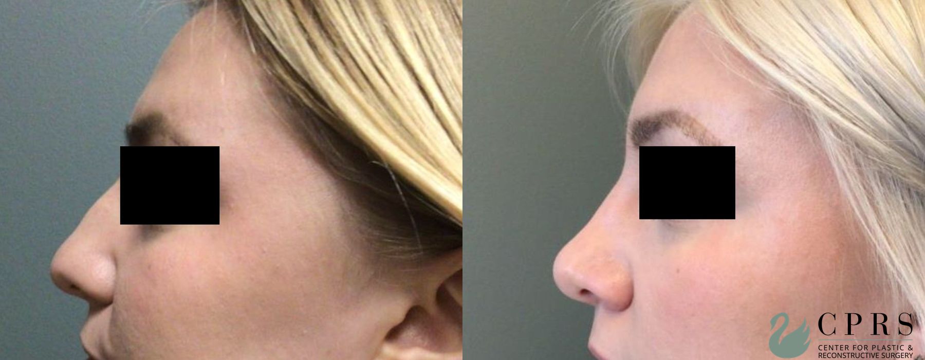 Before and after Rhinoplasty case 19027 - Angle 3