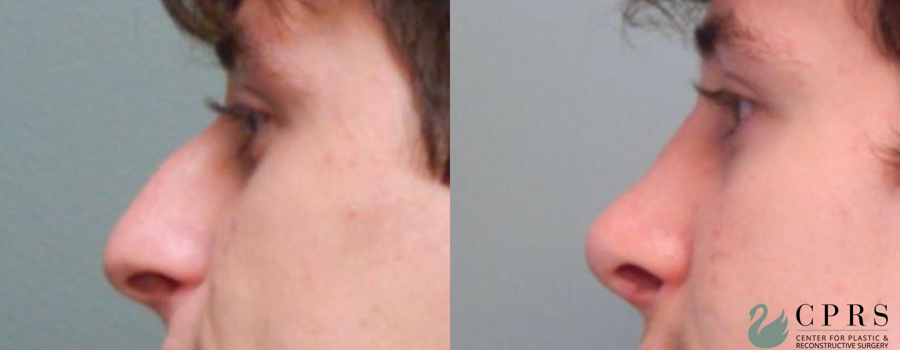 Before and after Rhinoplasty case 18956 - Angle 2
