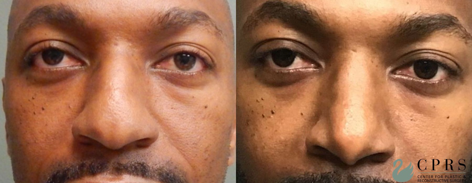 Before and after Rhinoplasty case 18932 - Angle 2