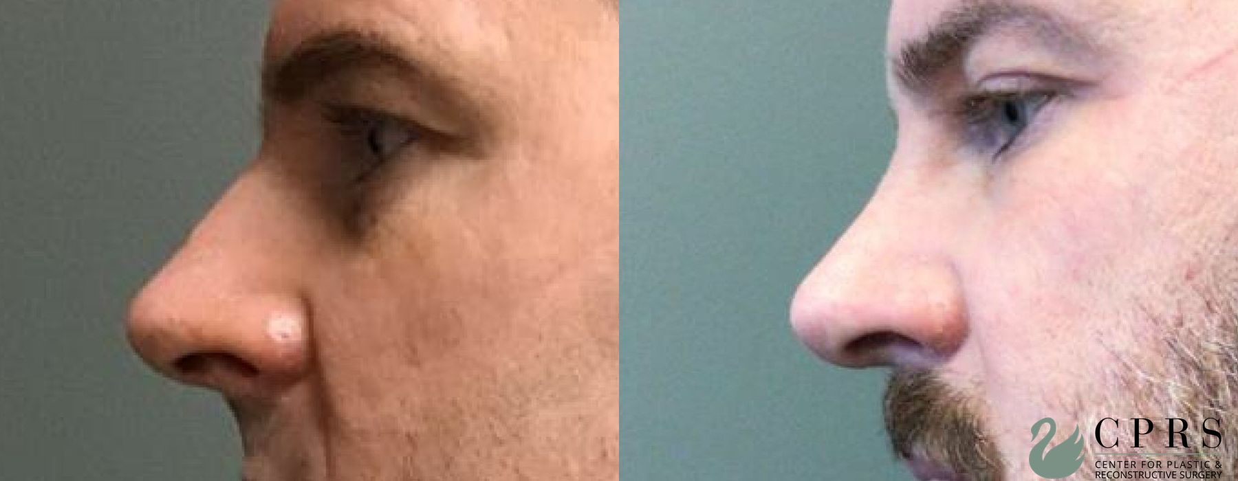 Before and after Rhinoplasty case 19085 - Angle 4