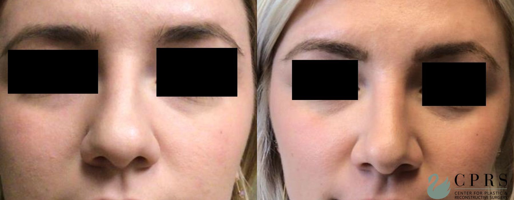 Before and after Rhinoplasty case 19027 - Angle 2